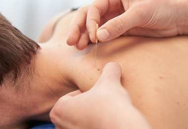 Dry needling (photo d'illustration)